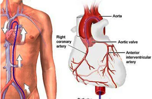 Coronary Angiography