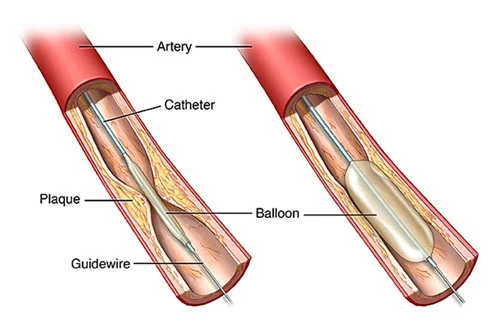 Coronary Angioplasty
